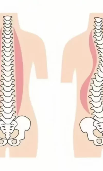 国家卫健委《脊柱弯曲异常筛查技术要点》，家长、老师、医疗机构适用
